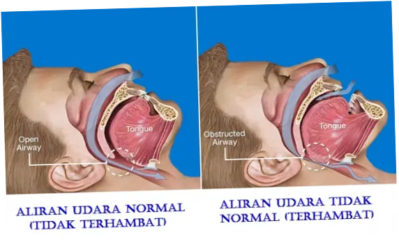 Mendengkur Jadi Tanda Gangguan Pernapasan pada Anak, Bisa Picu Tekanan Darah Tinggi