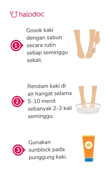 Tips Mencegah Kaki Kapalan, Jangan Lupa Gunakan Sepatu yang Pas